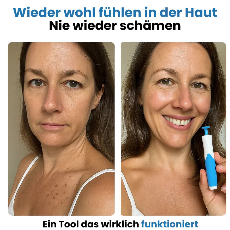 TagBuddy Kit – Keine Hautanhängsel mehr